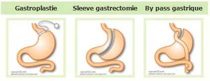 traitement de l'obésité par gastroplastie, sleeve gastrectomie ou by pass gastrique